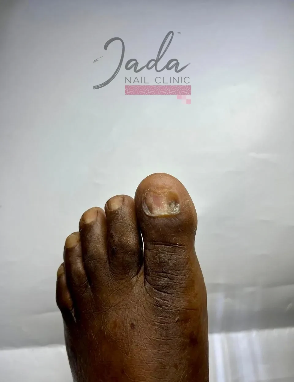 Healed and restored toenail showing successful recovery after a severe nail injury treatment at Jada Nail Clinic.