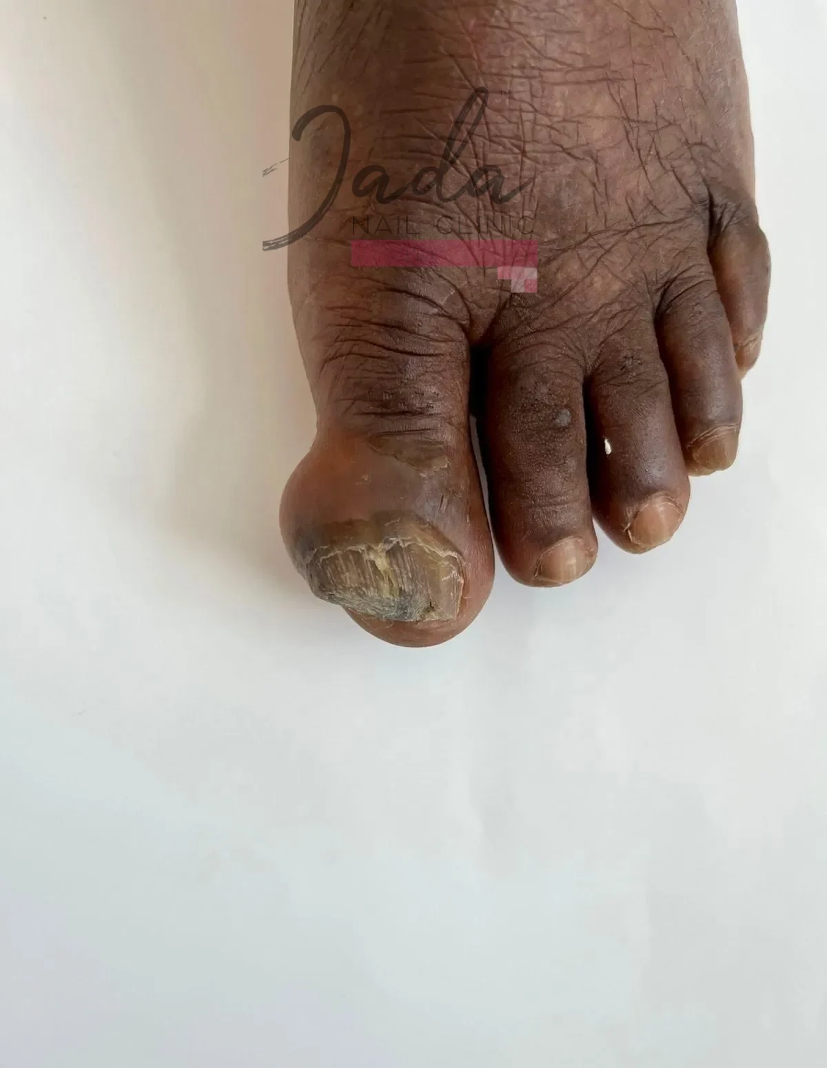 Traumatic toenail injury with bruising and visible nail damage before clinical podiatry care at Jada Nail Clinic.
