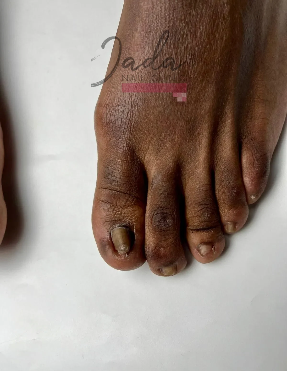 Clinical view of a severe ingrown toenail combined with nail lichen planus symptoms on the big toe before treatment at Jada Nail Clinic.