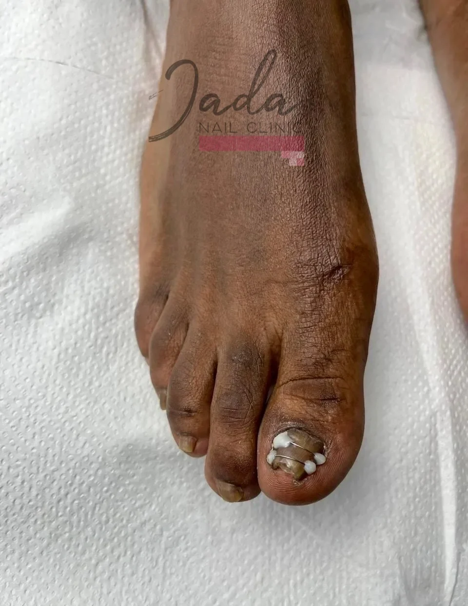 Healed and clear toenails showing a successful six-month recovery from an ingrown toenail and nail lichen planus at Jada Nail Clinic.