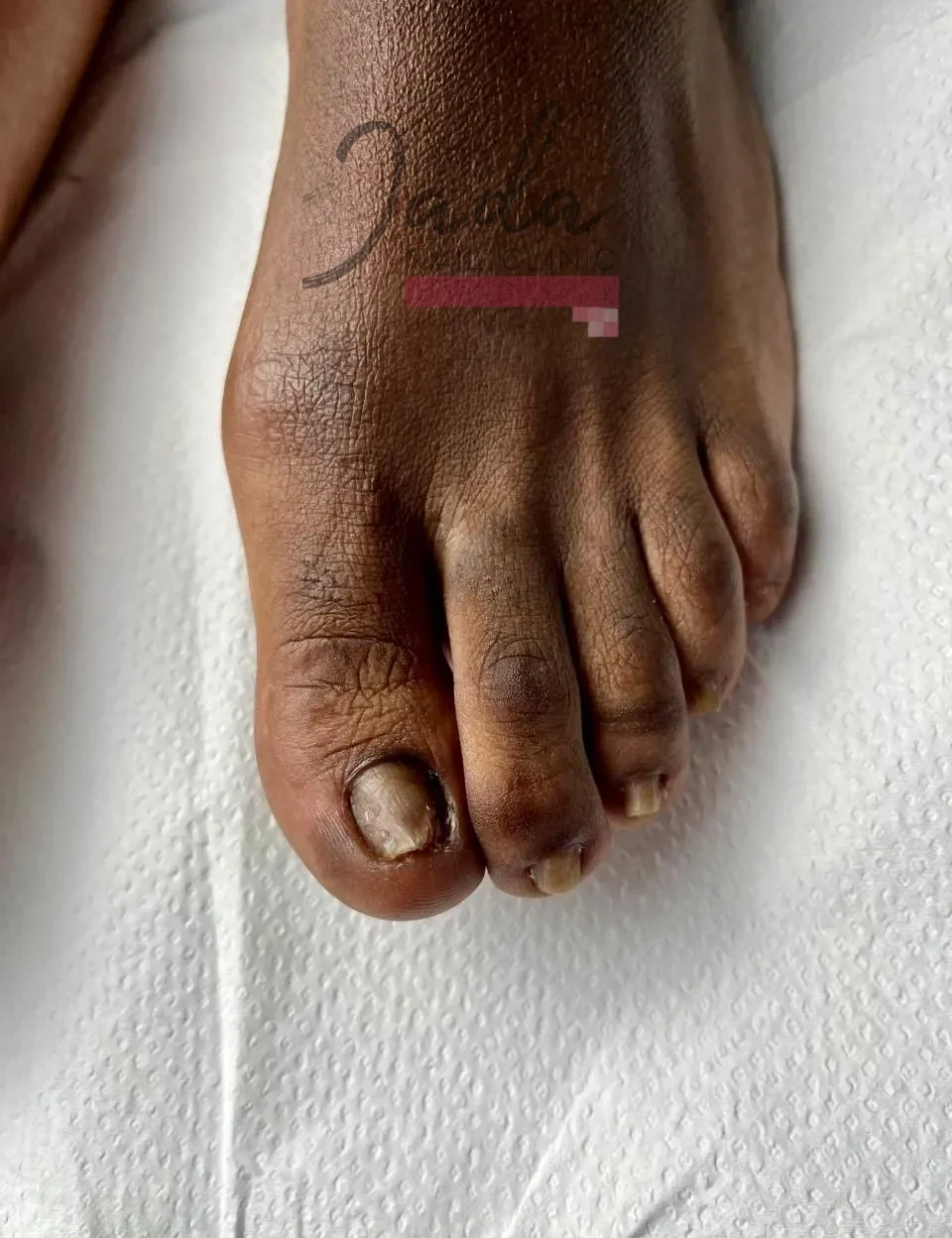 Healed and clear toenails showing a successful six-month recovery from an ingrown toenail and nail lichen planus at Jada Nail Clinic.