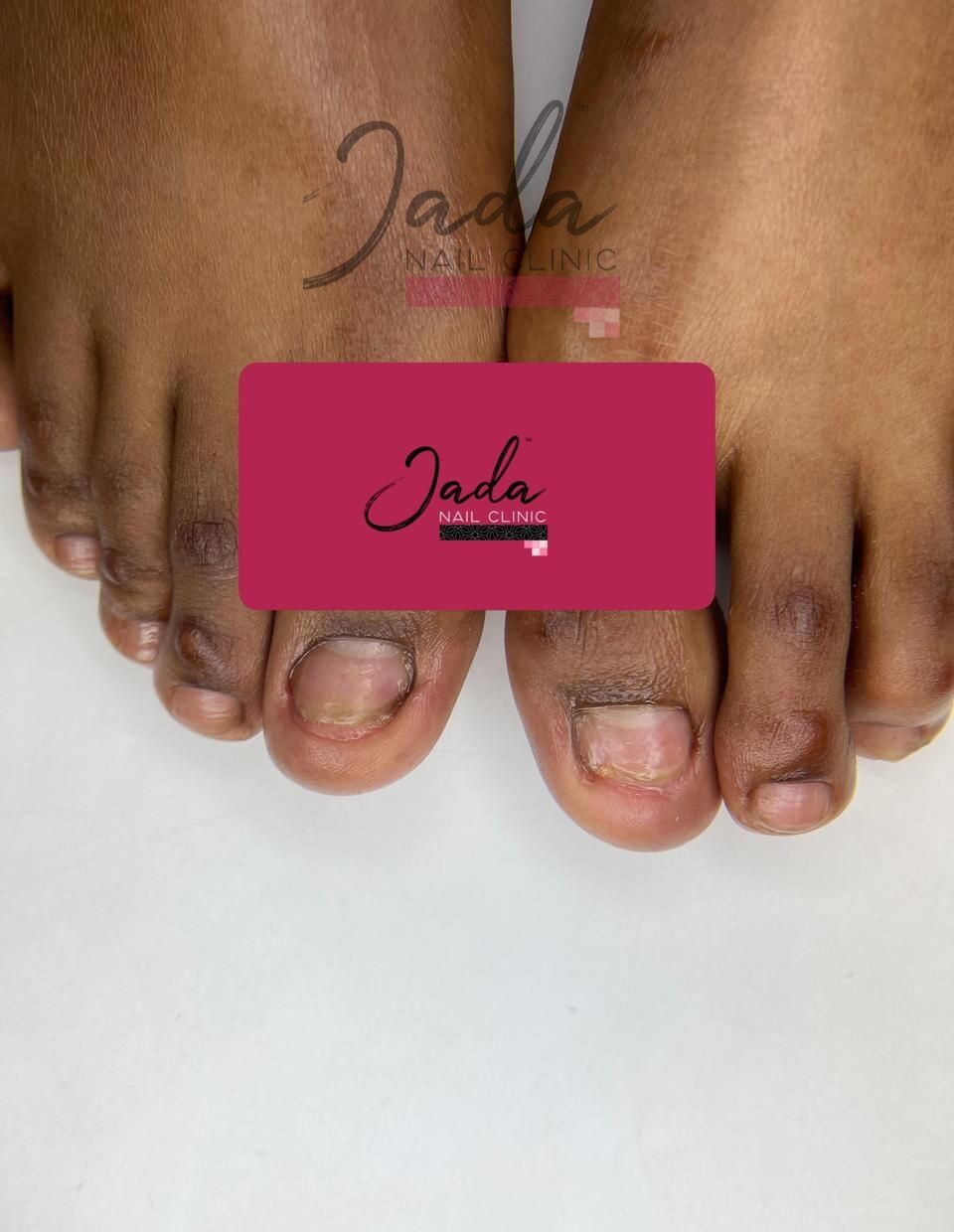 Successful Great Toe Dystrophy treatment results and healthy toenail recovery at Jada Nail Clinic.