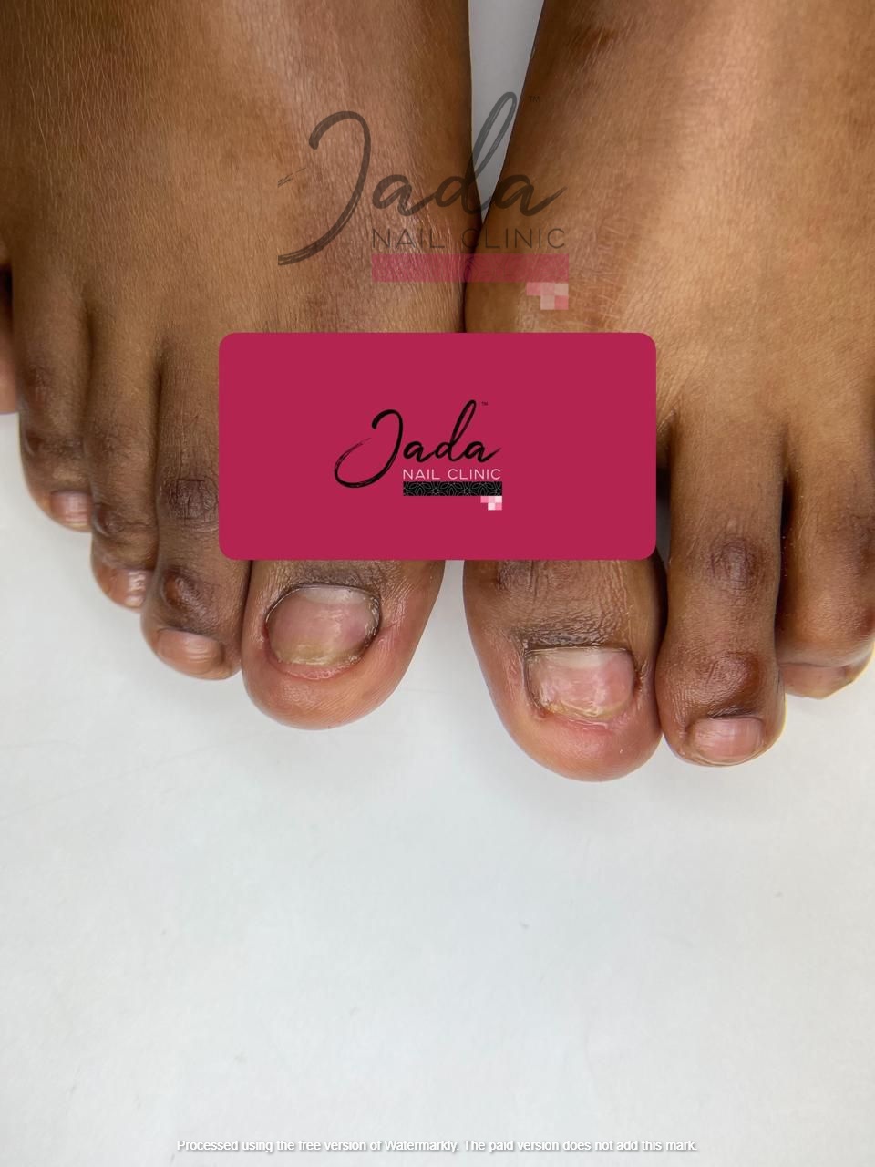Successful nail lichen planus treatment results and healthy toenail recovery at Jada Nail Clinic.