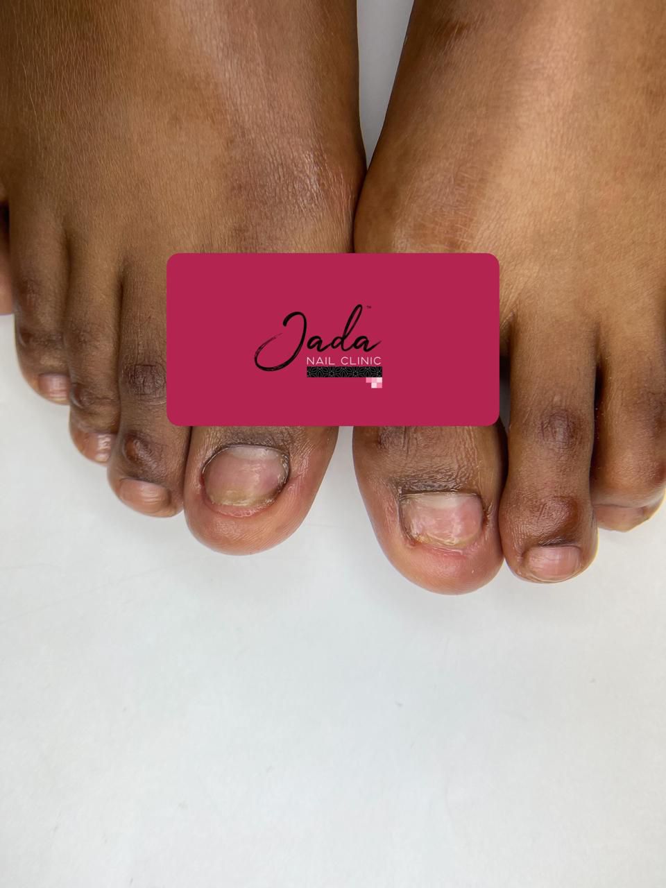 Successful nail lichen planus treatment results and healthy toenail recovery at Jada Nail Clinic.