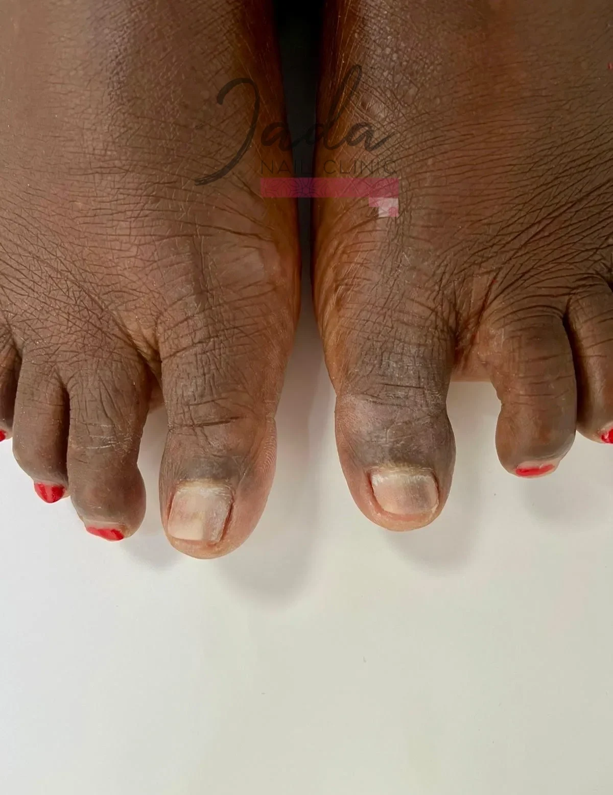 Severe nail psoriasis affecting the toenails with structural pitting and discoloration before clinical care at Jada Nail Clinic.