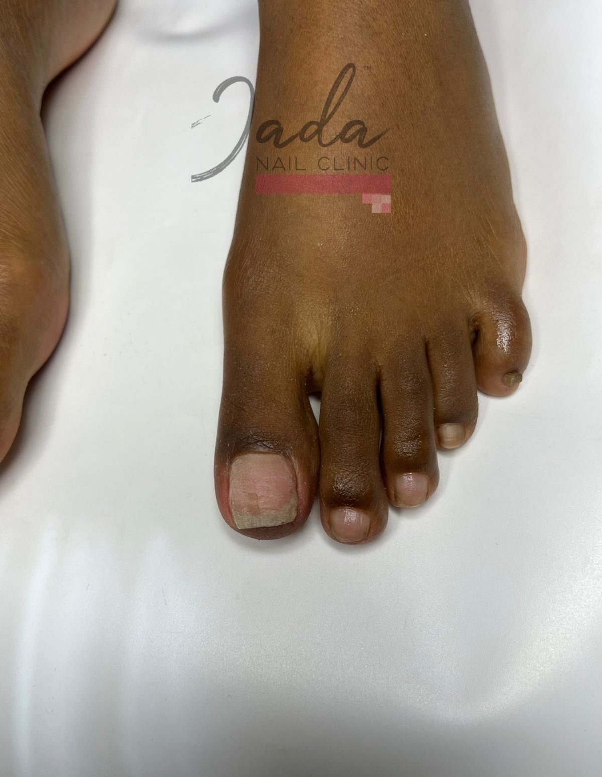 Successful ingrown toenail treatment results and healthy nail recovery at Jada Nail Clinic.