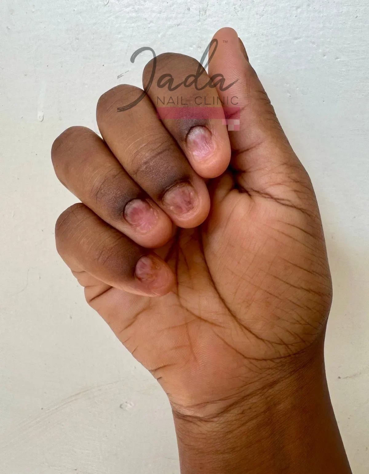 Severe nail lichen planus affecting the fingernails with visible ridges and thinning before clinical therapy at Jada Nail Clinic.