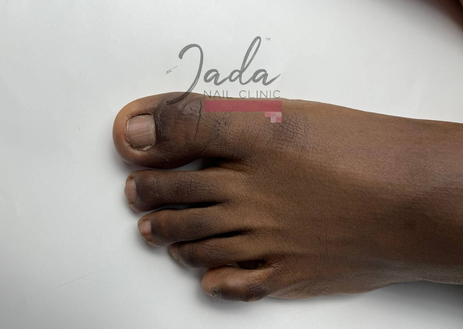 Painful ingrown toenail condition before specialized corrective treatment at Jada Nail Clinic.