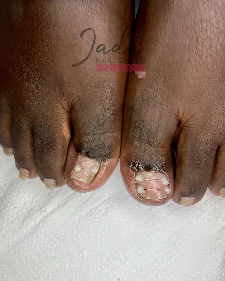 Fully healed and restored big toe after successful ingrown toenail treatment at Jada Nail Clinic.