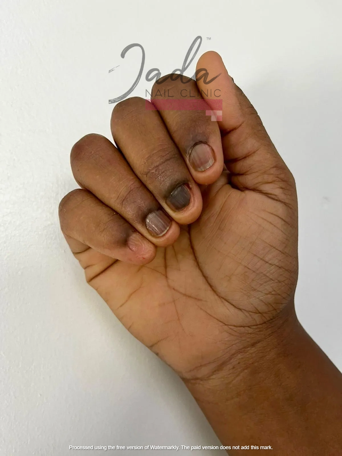 Healthy and completely restored fingernails one year after successful nail lichen planus treatment at Jada Nail Clinic.