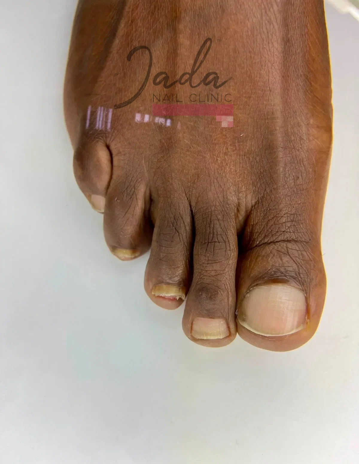 Clear and healthy toenail restoration one year after total dystrophic onychomycosis treatment at Jada Nail Clinic.