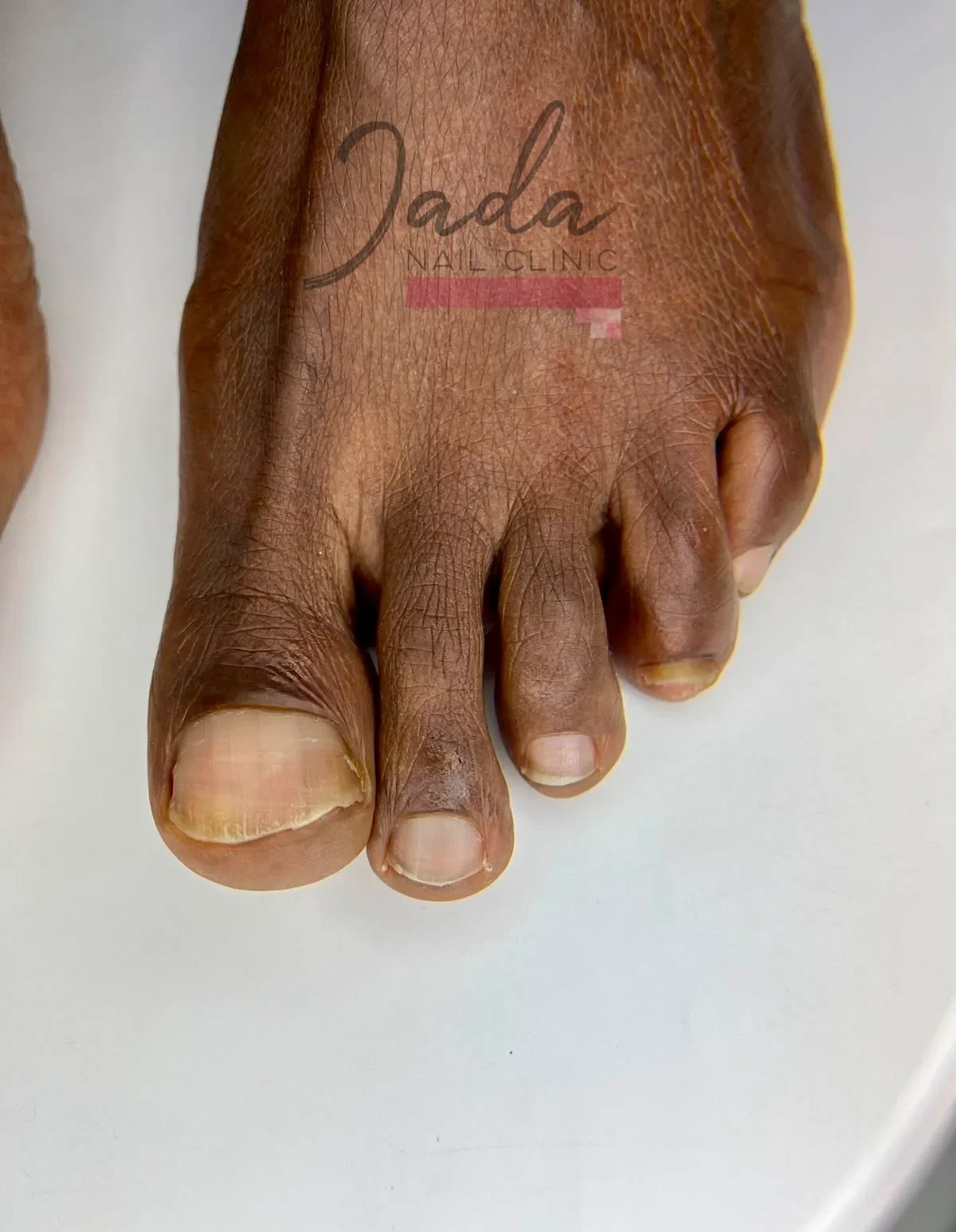 Clear and healthy toenails showing successful one year recovery from total dystrophic onychomycosis treatment at Jada Nail Clinic.