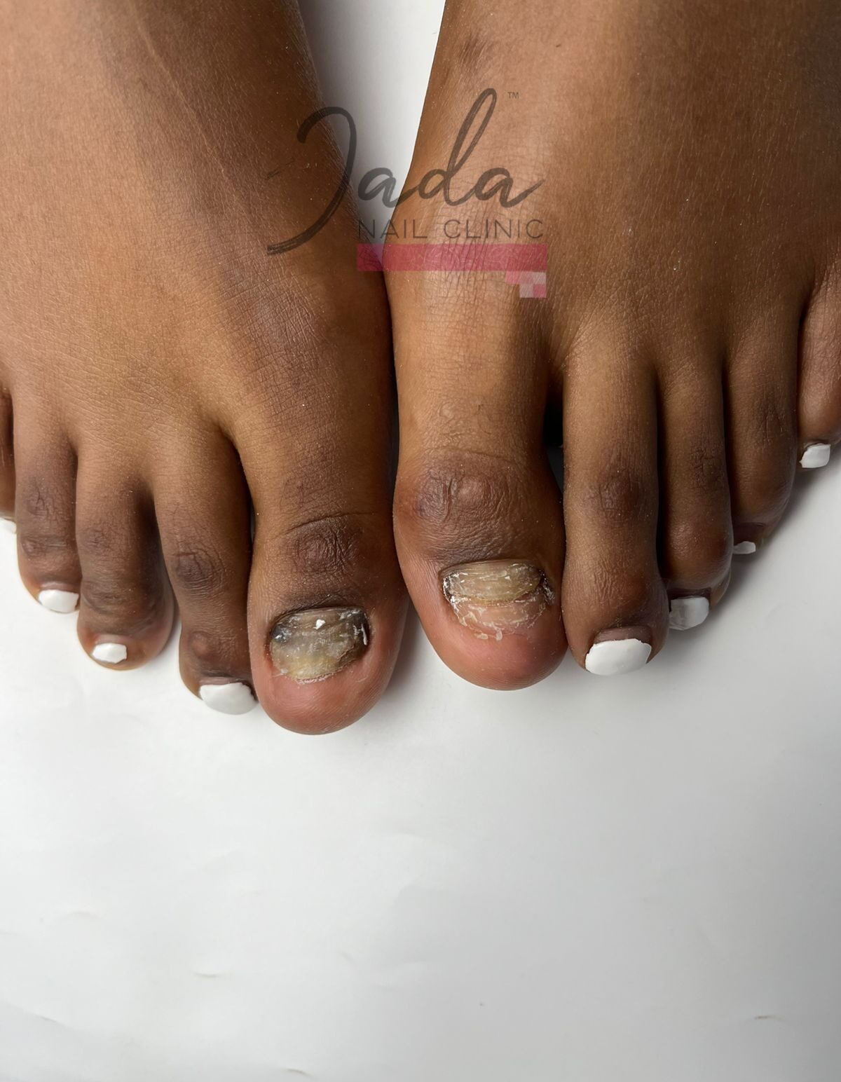 Severe Great Toe Dystrophy symptoms before therapeutic clinical treatment at Jada Nail Clinic.