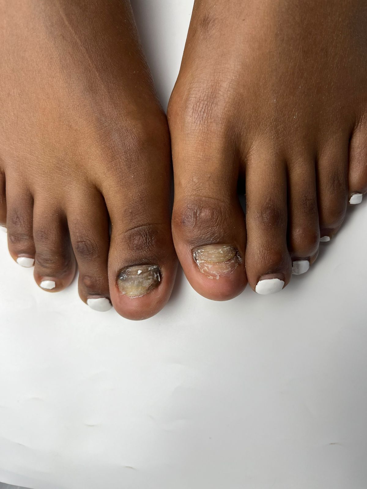 Severe nail lichen planus symptoms before therapeutic clinical treatment at Jada Nail Clinic.