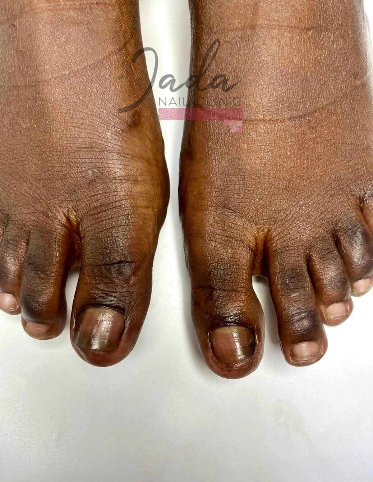 Fully recovered, clear, and healthy big toenails after great toe dystrophy treatment at Jada Nail Clinic.