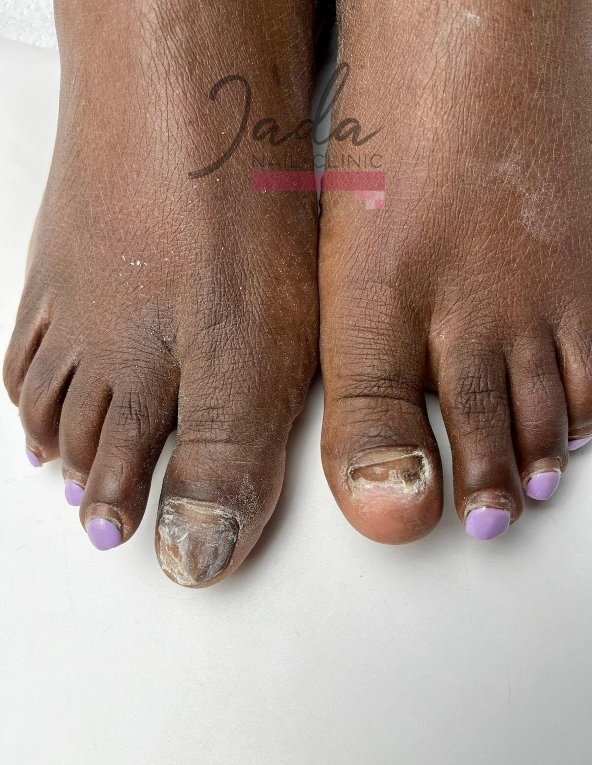 Severe great toe dystrophy and thickened toenail damage before corrective podiatric treatment at Jada Nail Clinic.