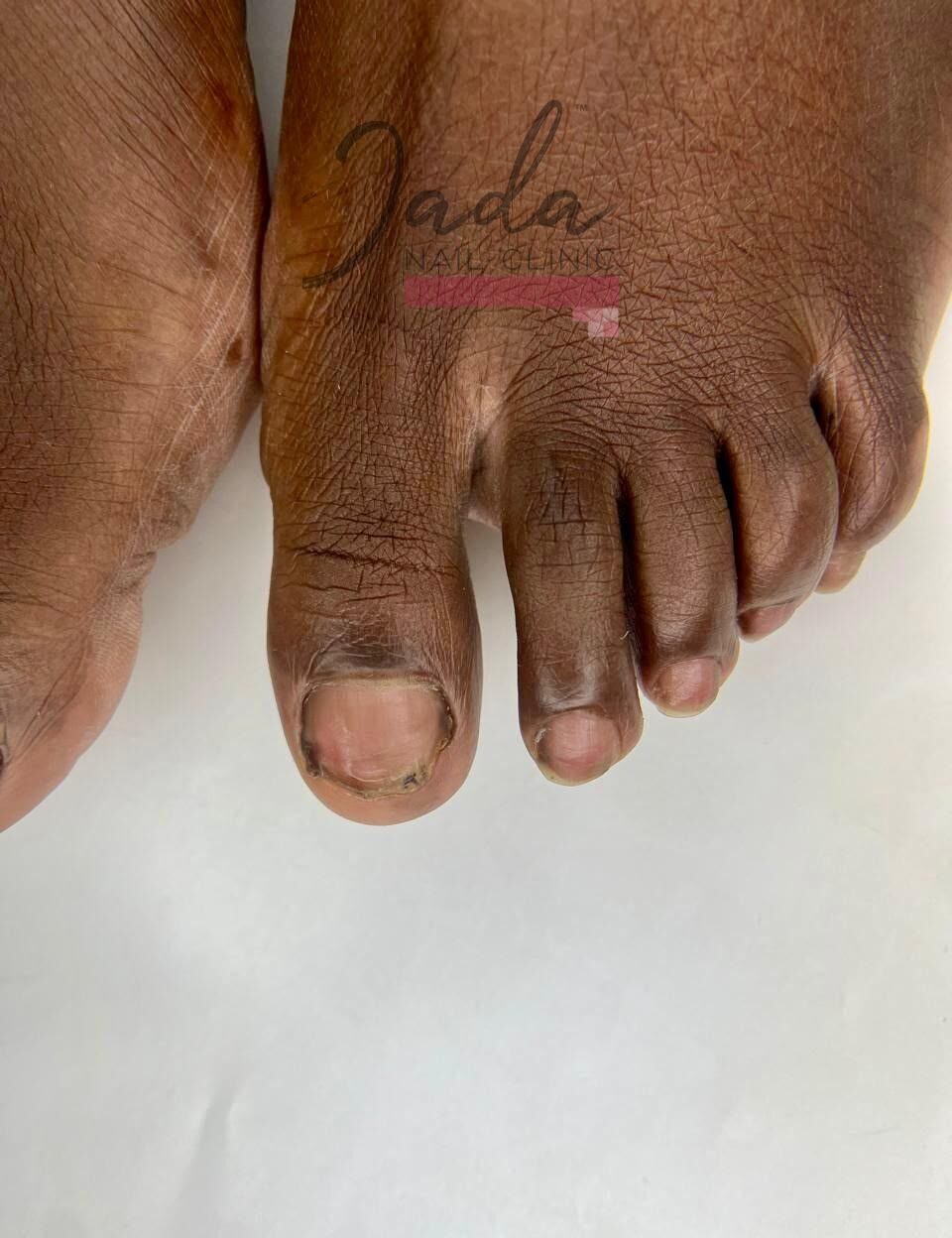 Severe great toe dystrophy and thickened toenail damage after corrective podiatric treatment at Jada Nail Clinic.
