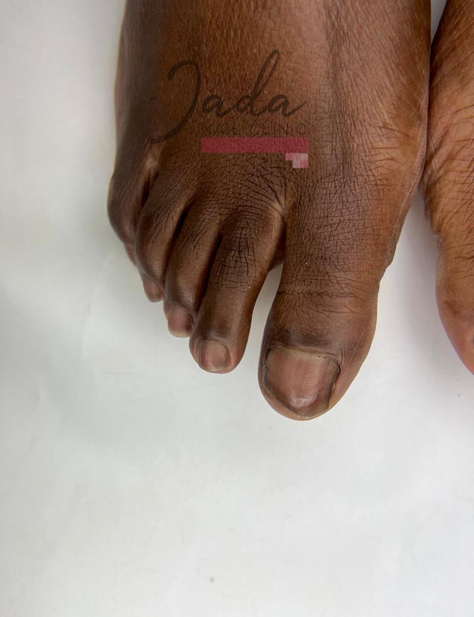 Fully recovered, clear, and healthy big toenails after great toe dystrophy treatment at Jada Nail Clinic.