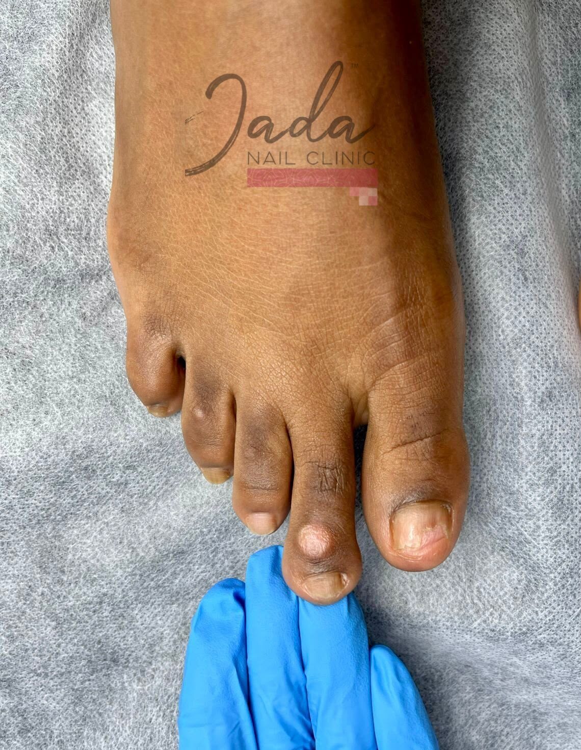 Severe toenail fungal infection and discolored nails before clinical treatment at Jada Nail Clinic.