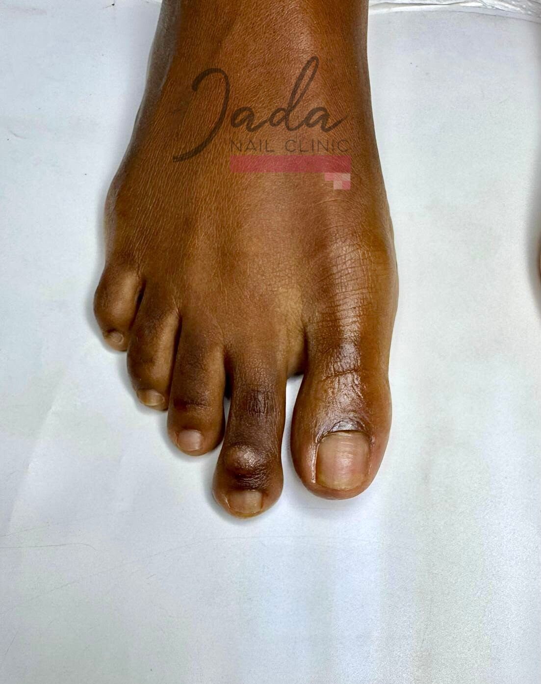 Fully recovered, clear, and healthy toenails after specialized fungal infection treatment at Jada Nail Clinic.