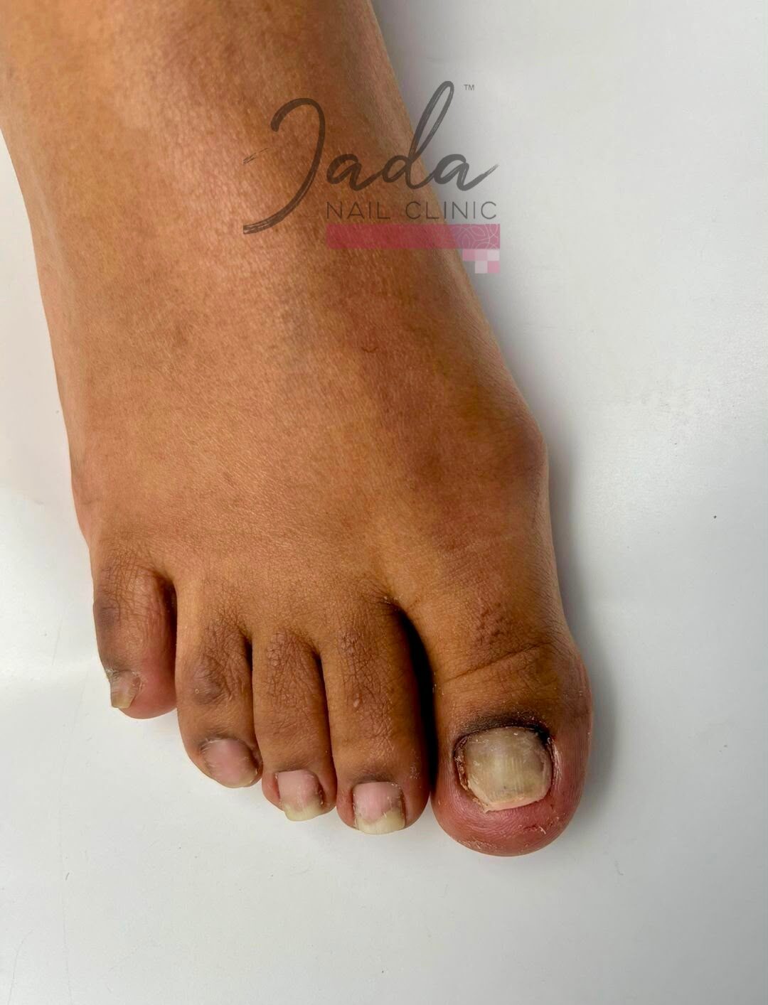 Severe trauma-induced nail injury on the big toe before corrective clinical treatment at Jada Nail Clinic.
