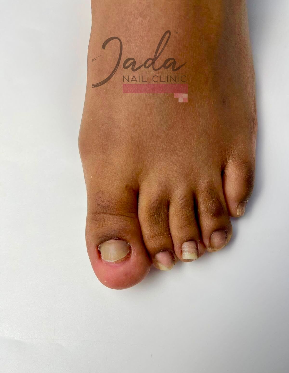 Traumatic nail injury on the big toe before specialized clinical repair at Jada Nail Clinic