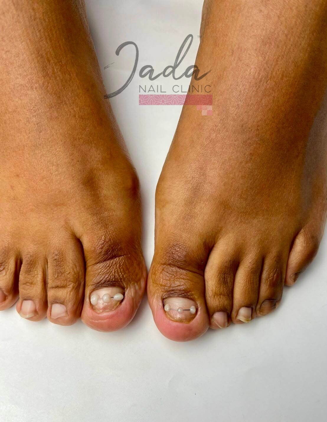 Fully recovered, clear, and healthy big toenail after specialized nail injury treatment at Jada Nail Clinic.