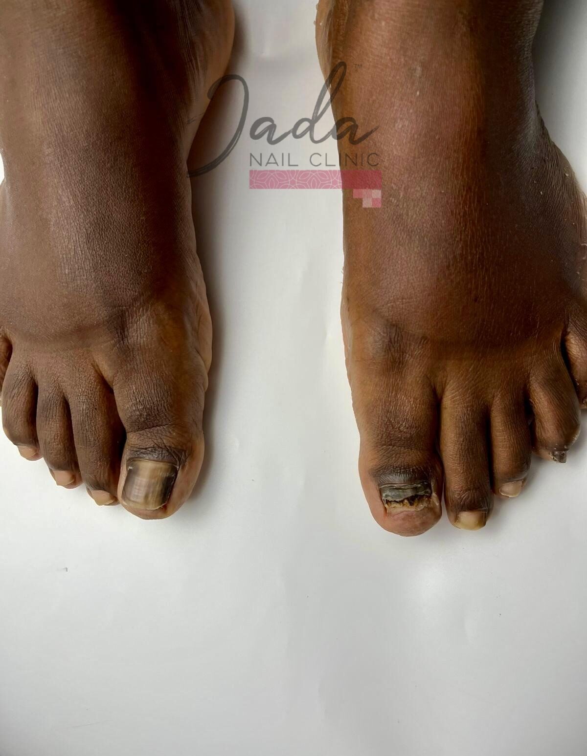 Advanced total dystrophic onychomycosis before restorative podiatric treatment at Jada Nail Clinic.