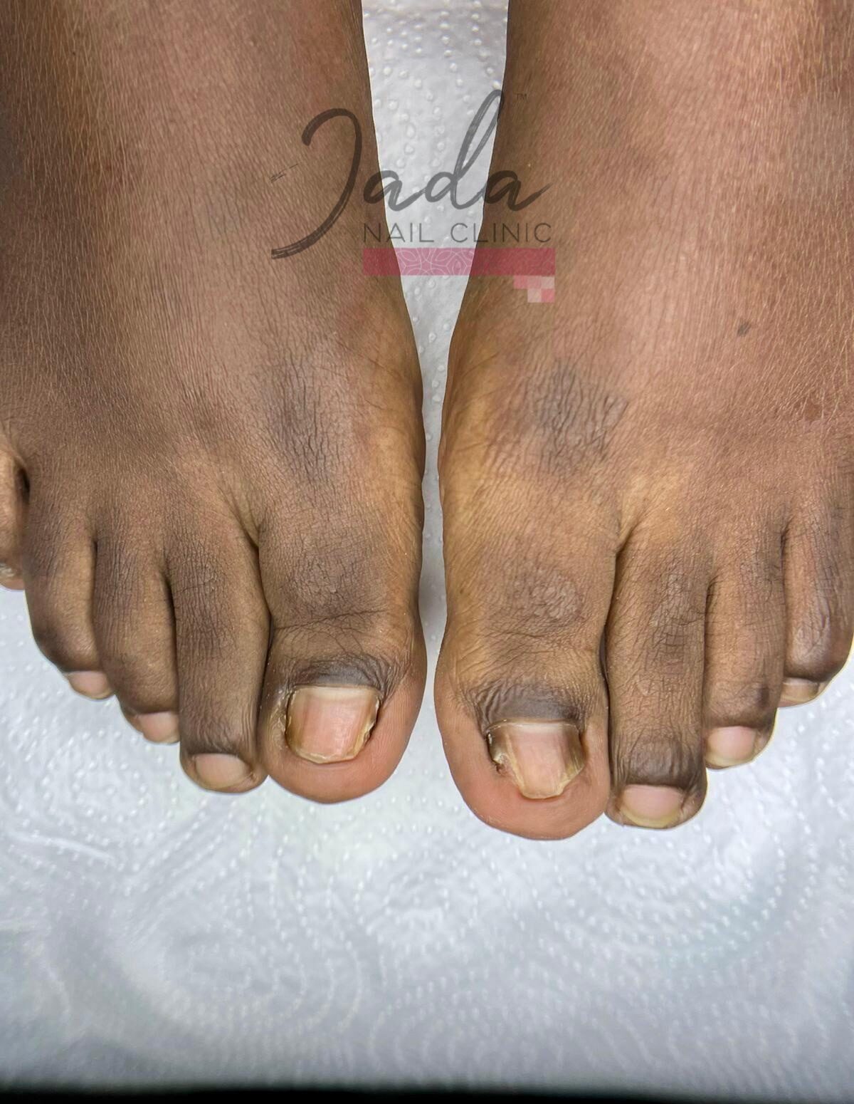 Complete toenail recovery and clear nail regrowth 6 months after total dystrophic onychomycosis treatment at Jada Nail Clinic.