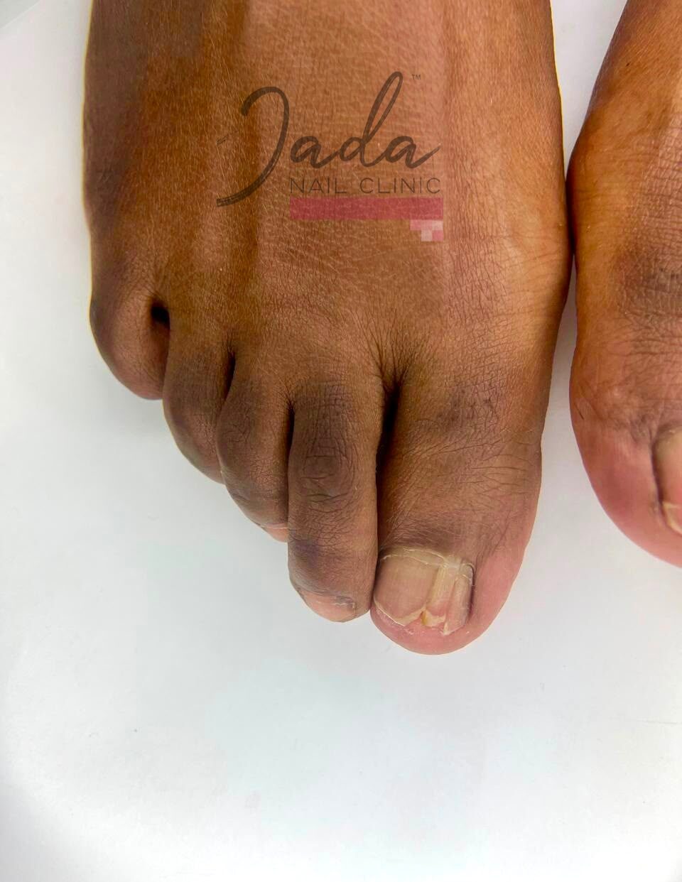 Clear and healthy toenail recovery showing successful restoration after fungal infection and nail dyschromia therapy at Jada Nail Clinic.