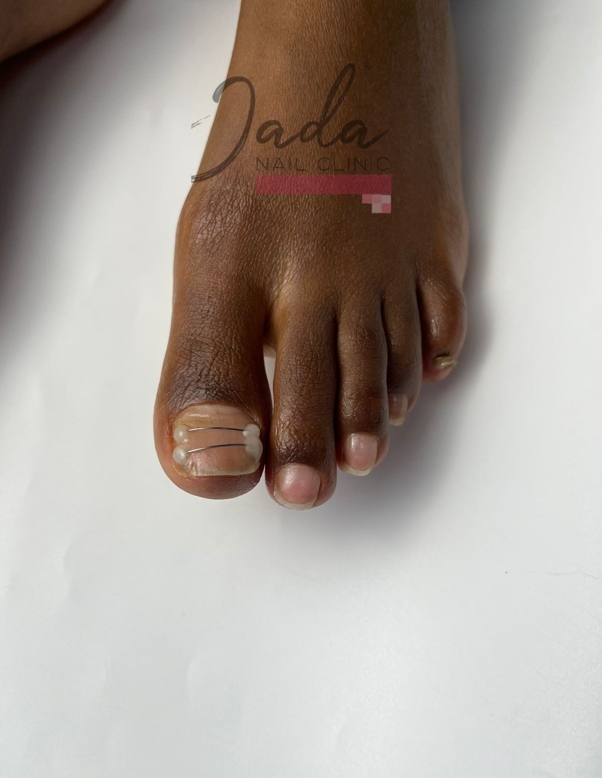 Specialized ingrown toenail bracing and corrective treatment before recovery at Jada Nail Clinic.