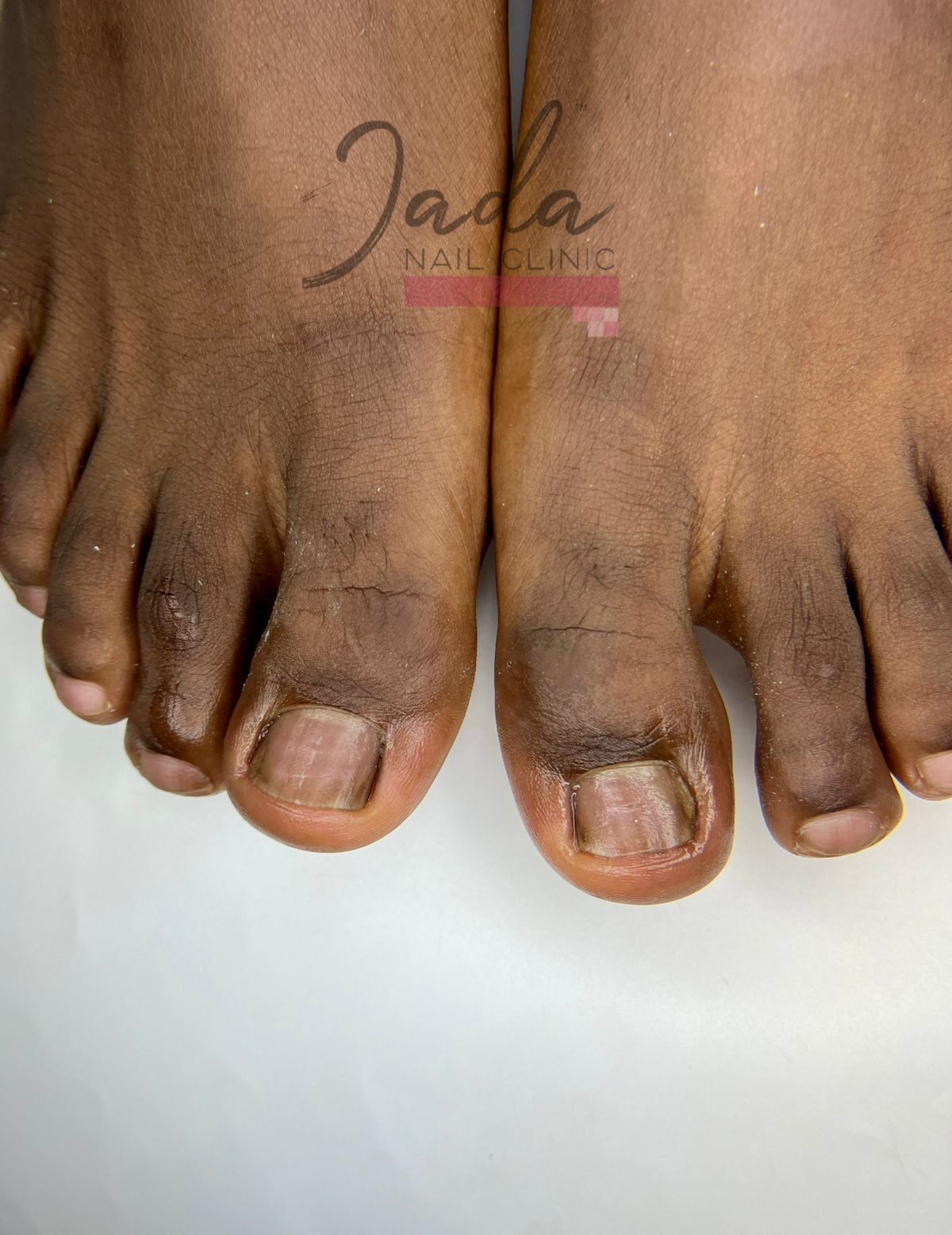 Successful ingrown toenail treatment results and healthy nail recovery at Jada Nail Clinic.