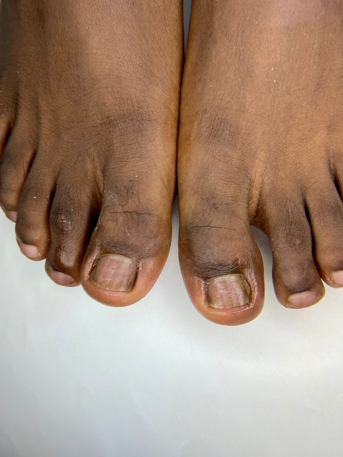 Successful ingrown nail treatment results and post-procedure recovery at Jada Nail Clinic.