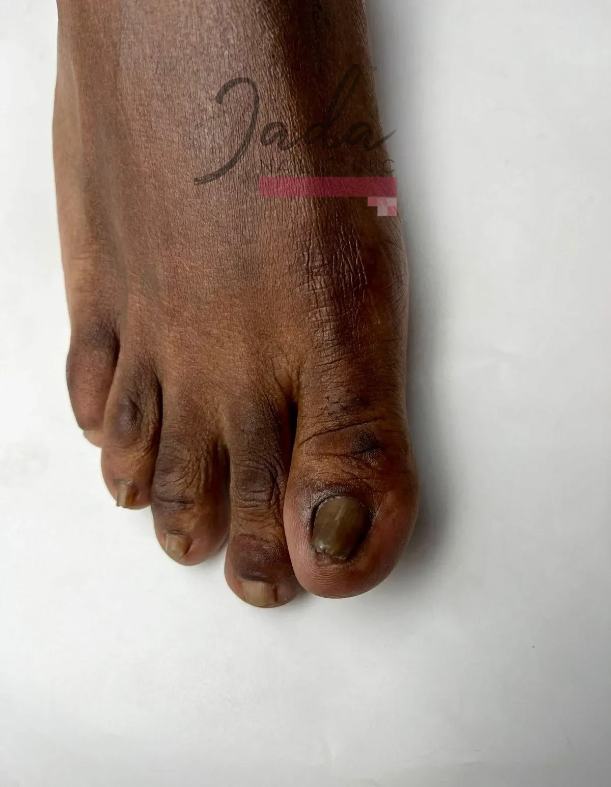 Clinical view of an ingrown toenail and nail lichen planus condition before professional therapy at Jada Nail Clinic.