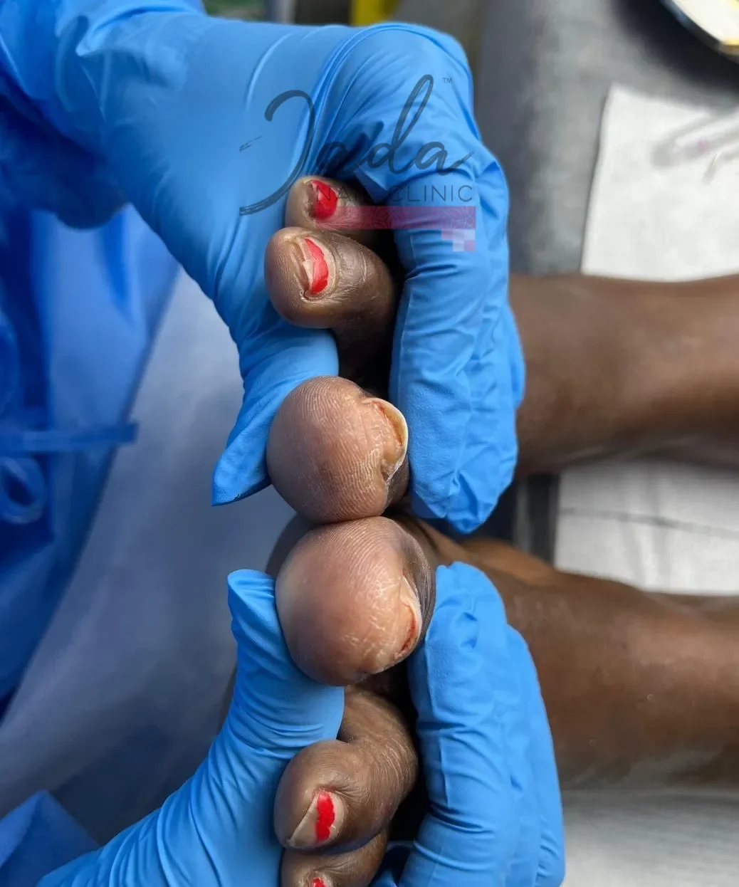 Severe nail psoriasis affecting the nails with pitting and discoloration before clinical treatment at Jada Nail Clinic.